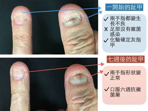 指甲斷了|指甲專家 陳逸懃醫師: 為什麼我的指甲容易斷裂？塗再。